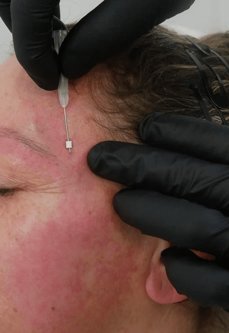 Eyebrows & Cat Eye PDO Thread Lift Boca Raton FL