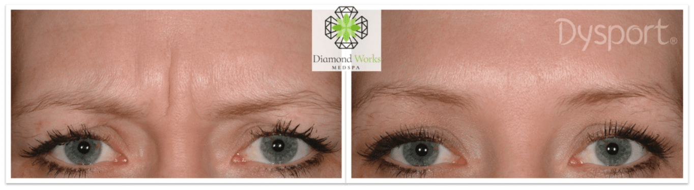 before and after Dysport Injections Treatment Boca Raton FL