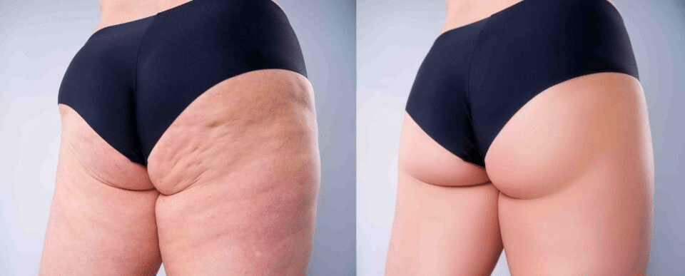 before after Sculptra Body Filler Boca Raton FL