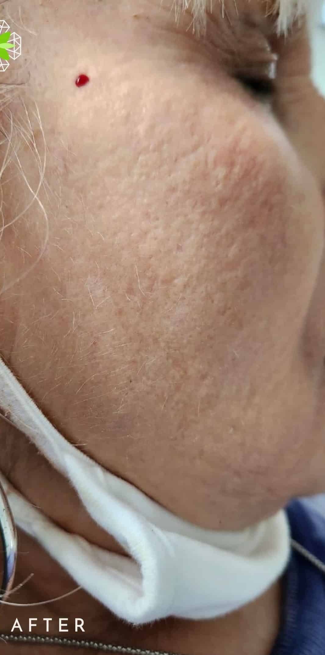 After Image: Cheek Filler - right-front-oblique