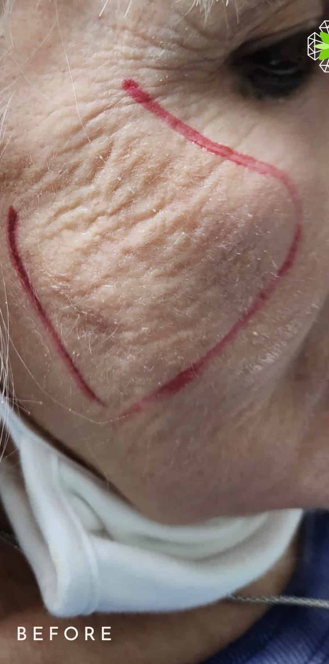 Before Image: Cheek Filler - right-front-oblique