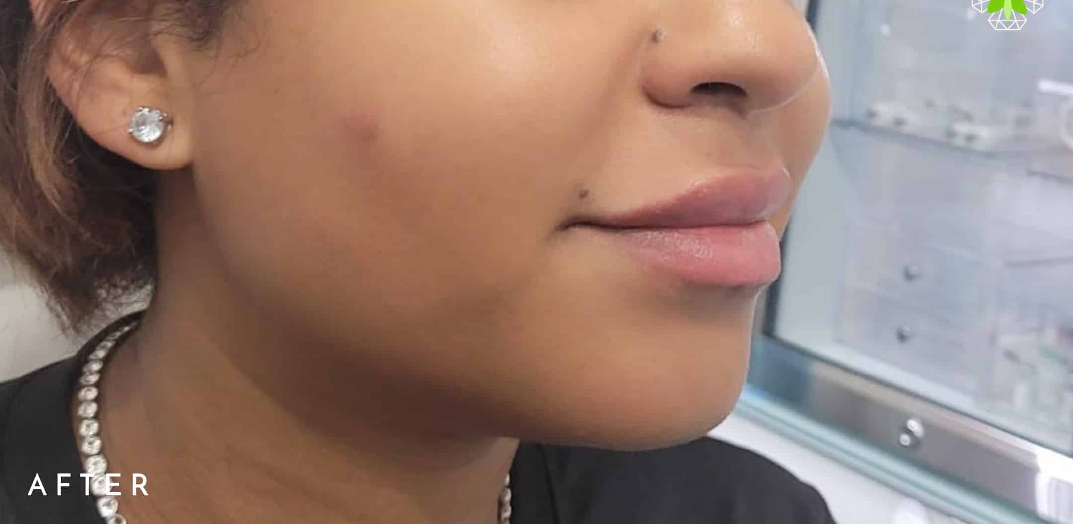 After Image: Lip Filler - right-front-oblique