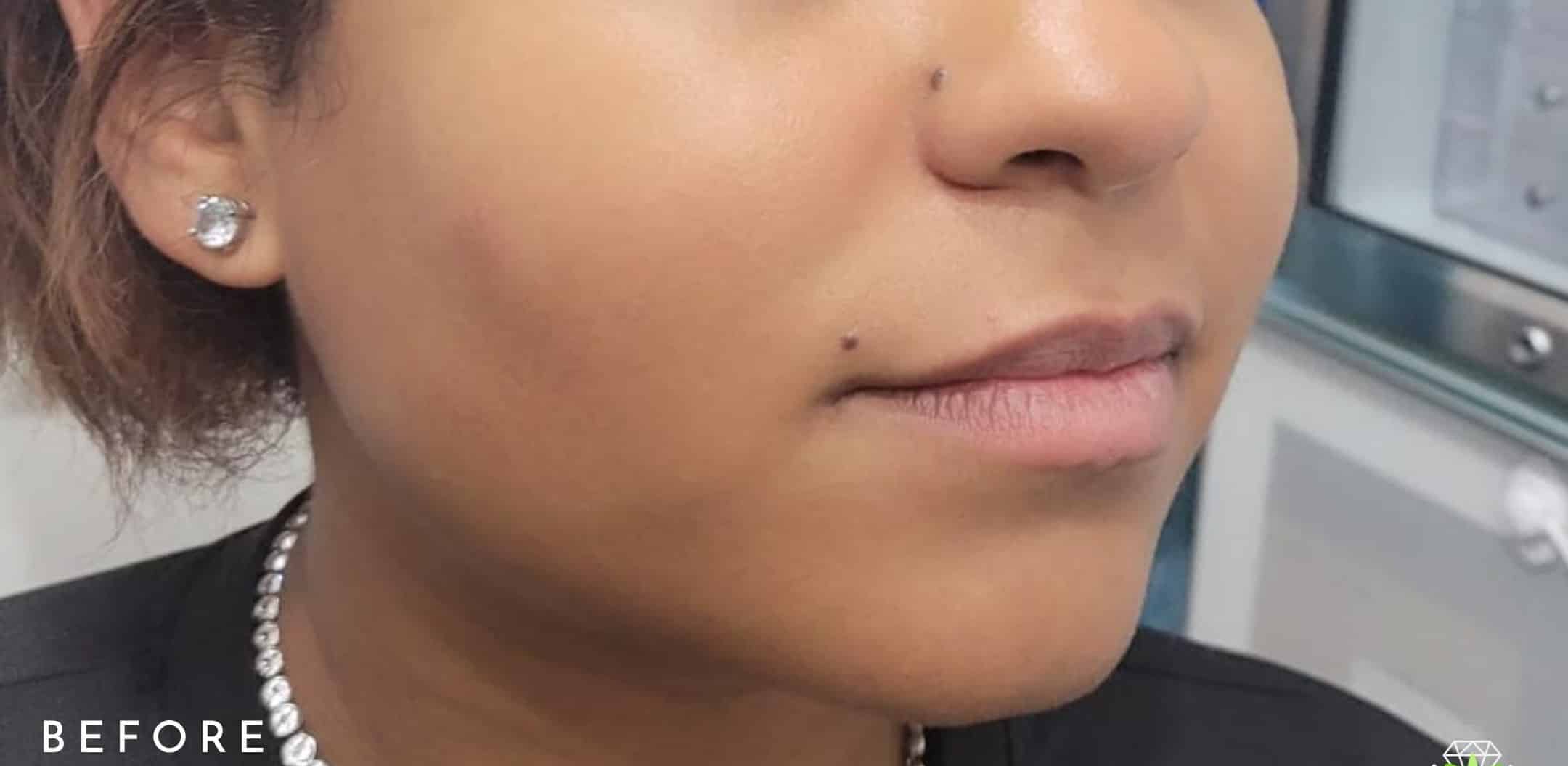 Before Image: Lip Filler - right-front-oblique