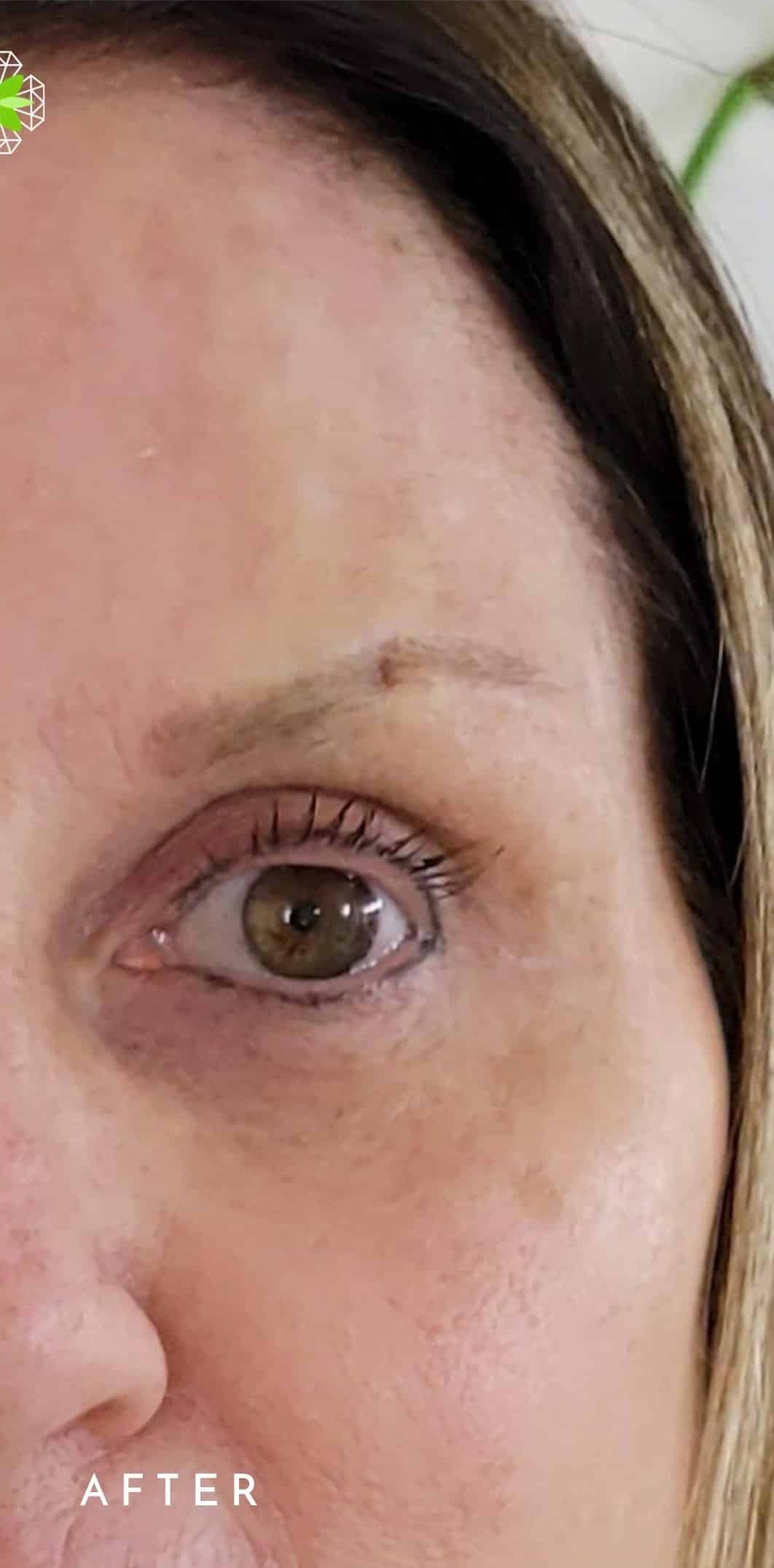 After Image: Mini Eye Lift - front