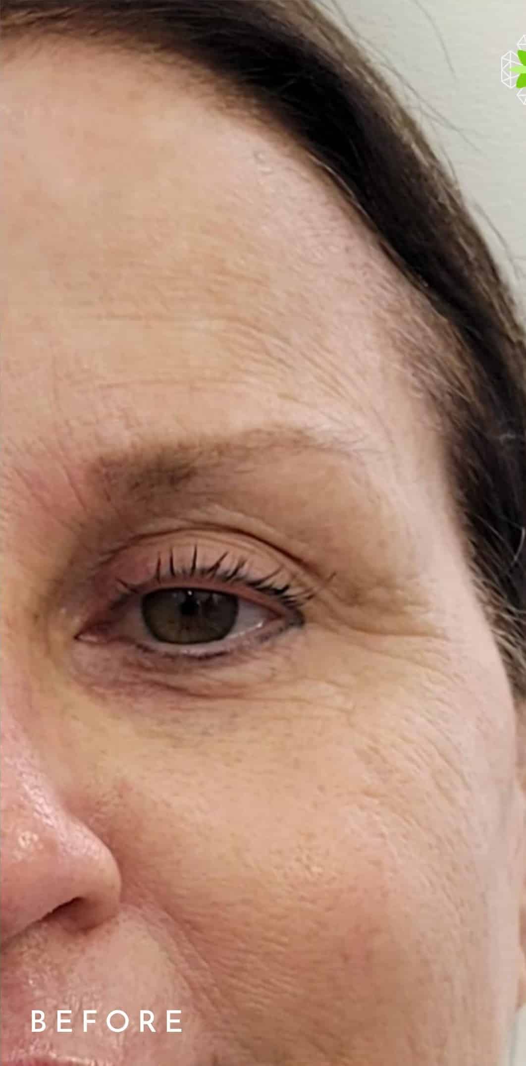 Before Image: Mini Eye Lift - front