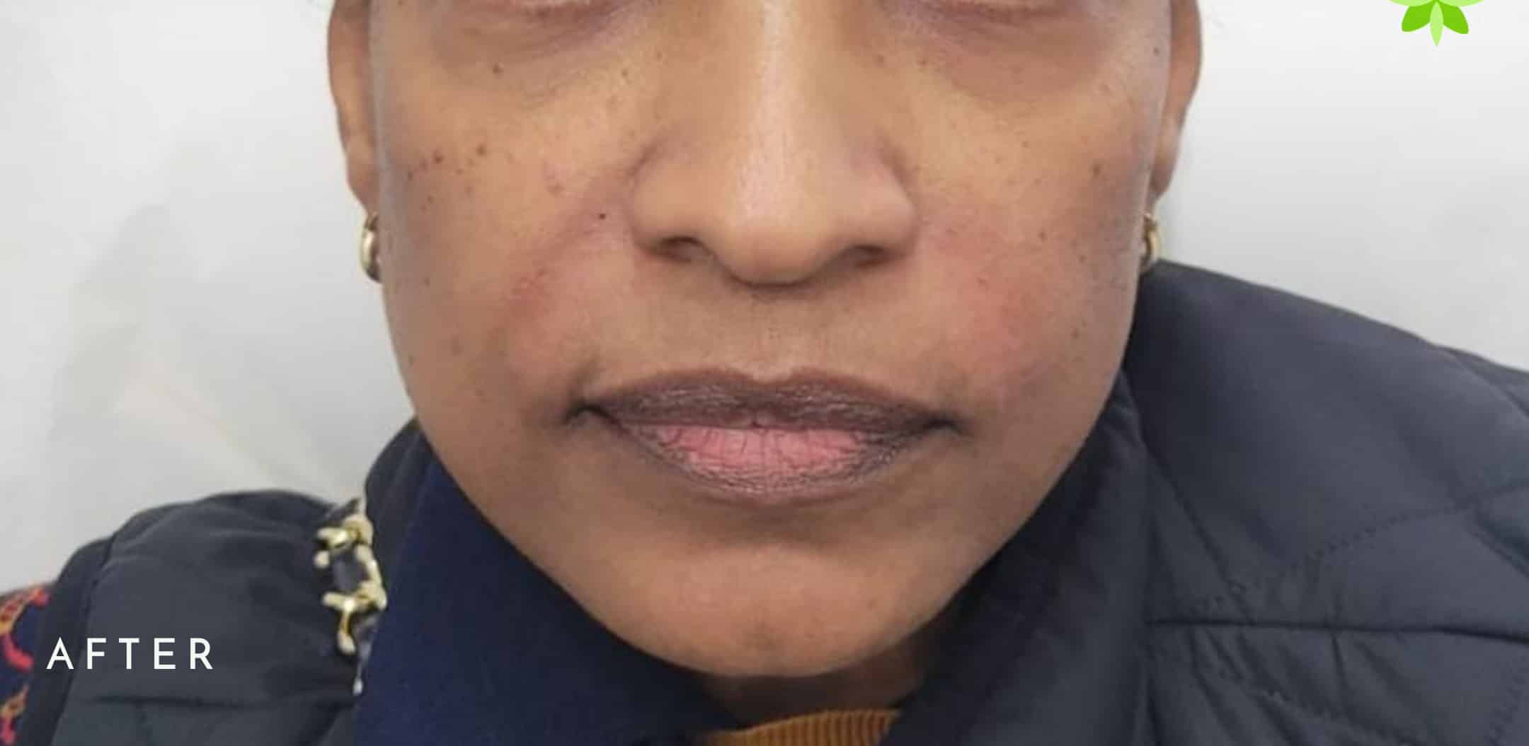 After Image: Nasolabial Fold Filler - front