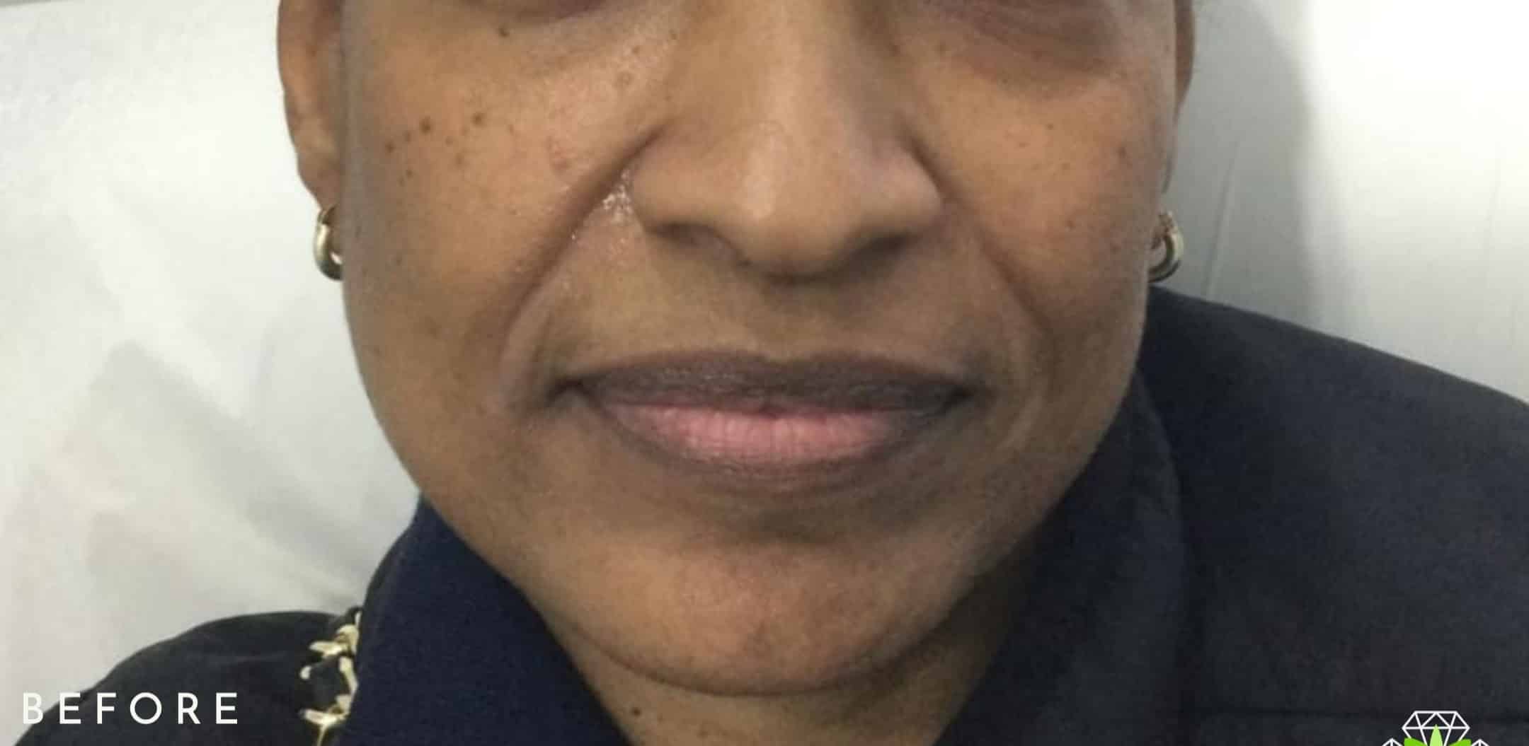 Before Image: Nasolabial Fold Filler - front
