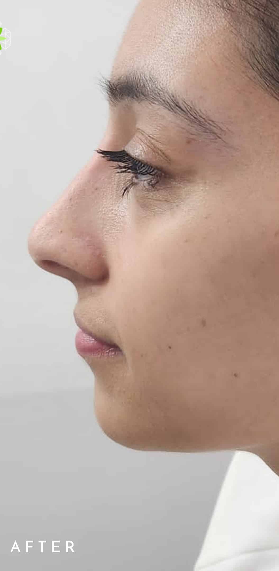 After Image: Non-Surgical Nose Lift - left-side