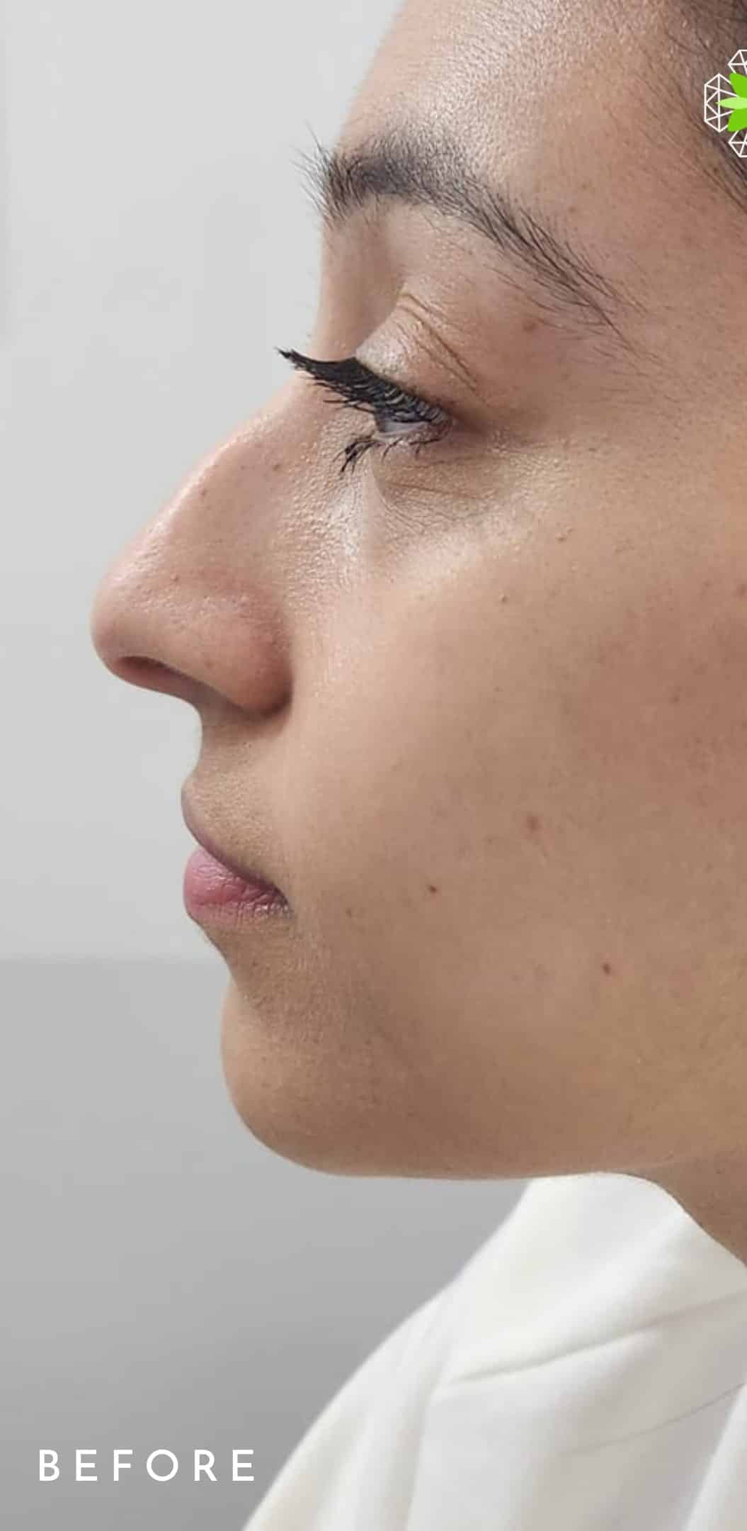 Before Image: Non-Surgical Nose Lift - left-side