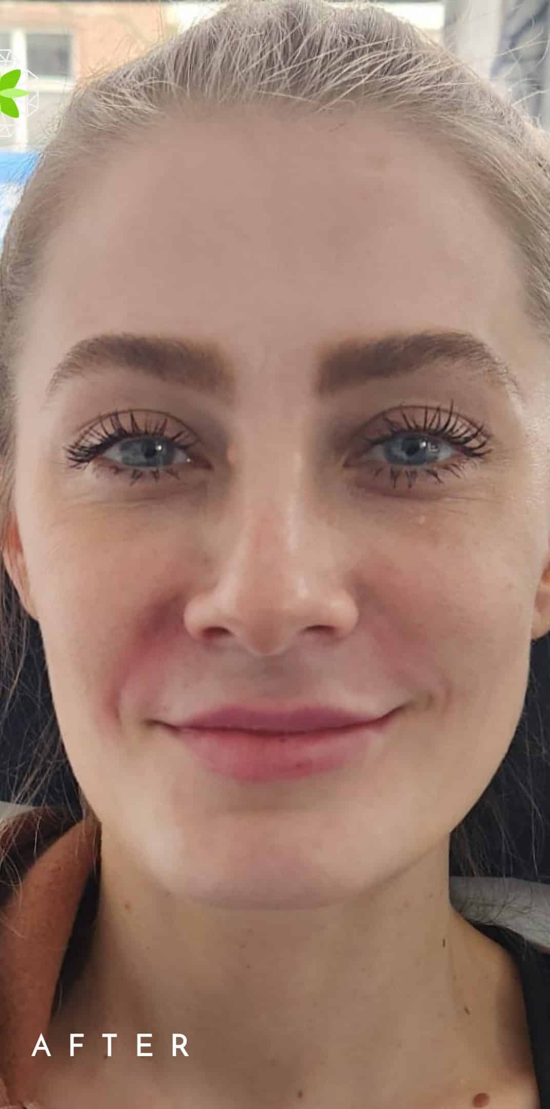 After Image: Under Eyes Filler - front