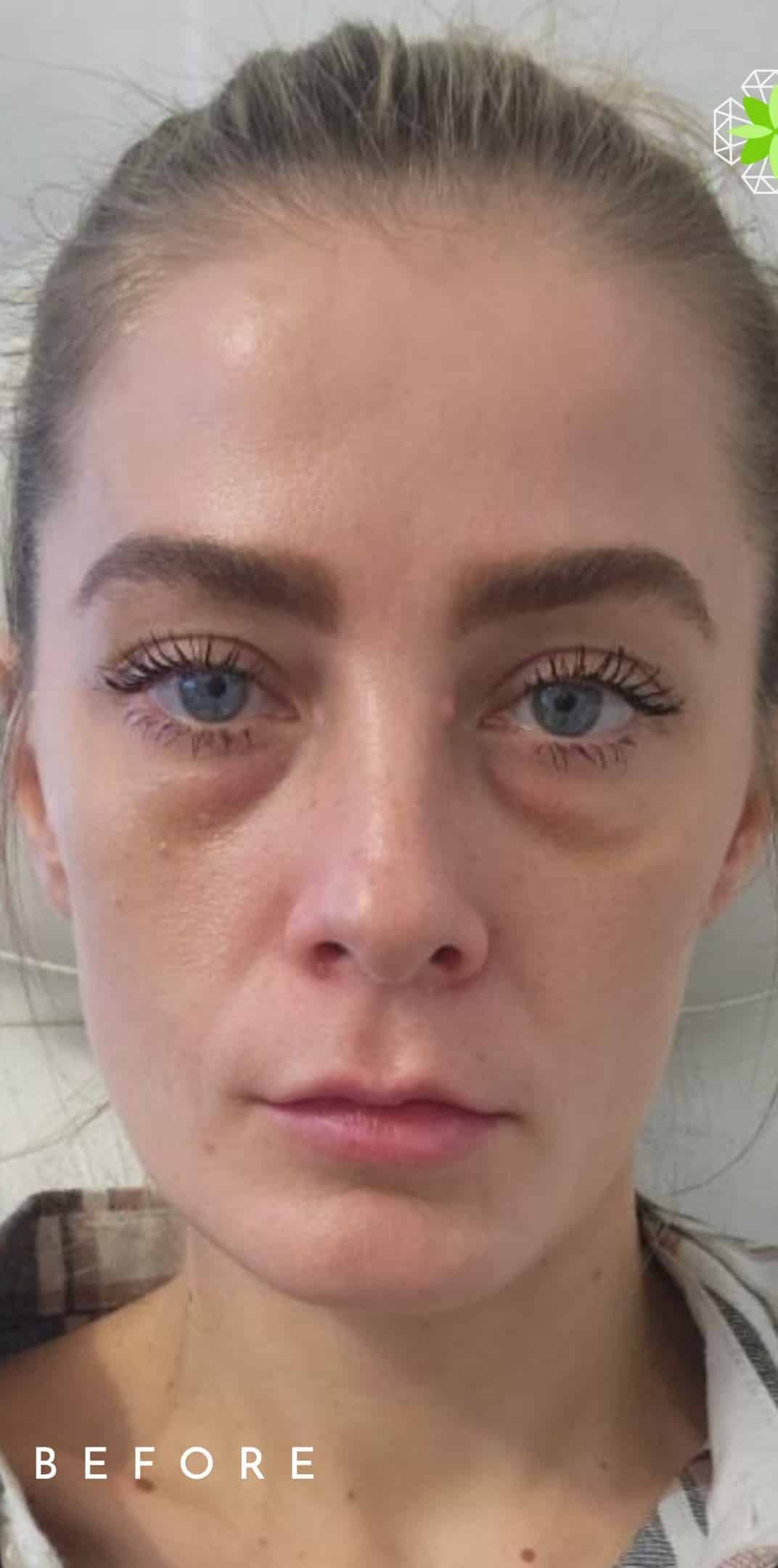 Before Image: Under Eyes Filler - front