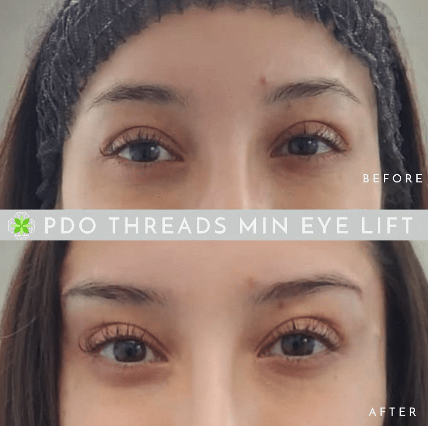 before after Eyebrows & Cat Eye PDO Thread Lift Boca Raton FL