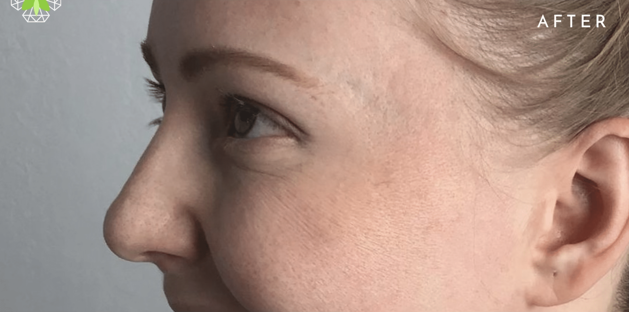 After Image: Botox - left-front-oblique