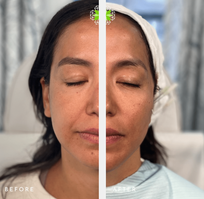 before after Upper & Lower Cheeks PDO Thread Lift Boca Raton FL